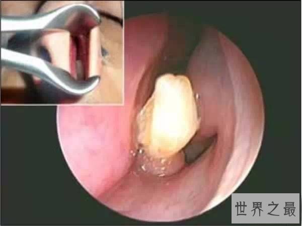 盘点世界上十大最奇怪的牙齿,重口味慎入