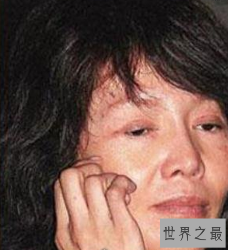 世界十大整容失败案例,最疯狂的是取出66克的硅胶?