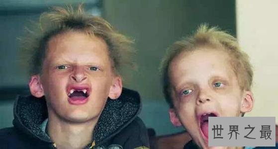 世界十二大最恐怖的怪病,世界上真有狼人症!