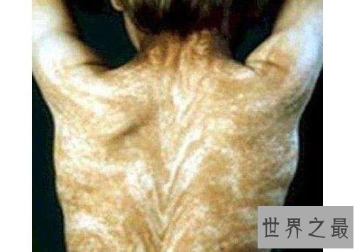 世界十二大最恐怖的怪病,世界上真有狼人症!