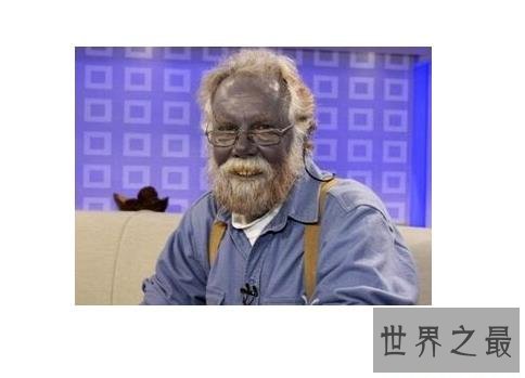 世界十二大最恐怖的怪病,世界上真有狼人症!