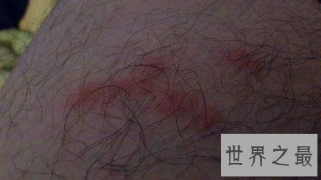 世界十二大最恐怖的怪病,世界上真有狼人症!