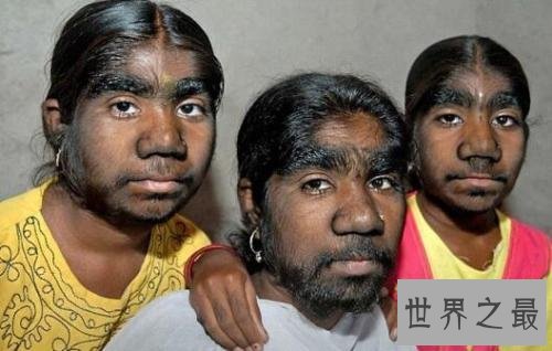 世界十二大最恐怖的怪病,世界上真有狼人症!