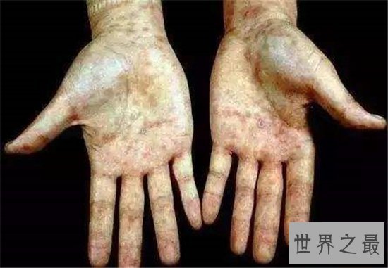 世界上最危险的10种细菌,梅毒高居榜首!