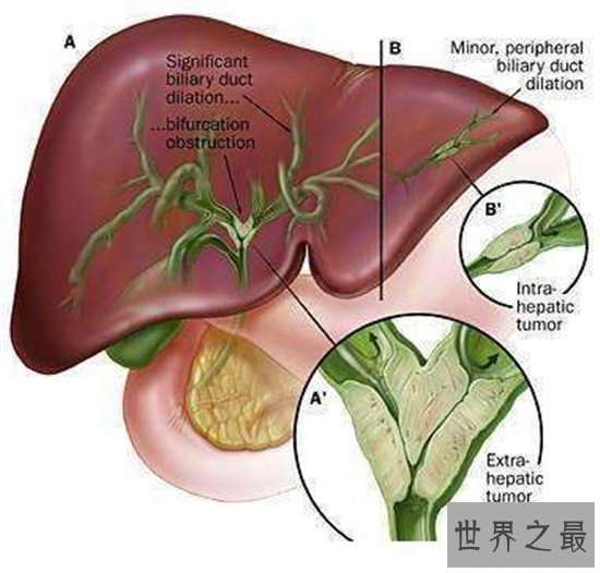 十大致命类型的癌症,都是很难治愈的癌症!