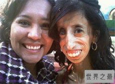 世界上最瘦的人，面目全失如同干尸