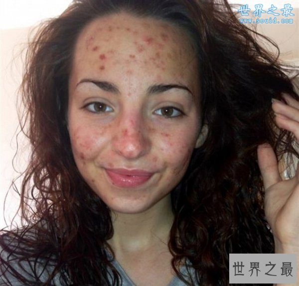 世界20大匪夷所思的罕见怪病，胆小慎看(图)