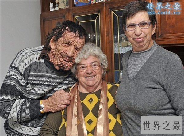 世界20大匪夷所思的罕见怪病，胆小慎看(图)