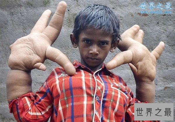 世界20大匪夷所思的罕见怪病，胆小慎看(图)