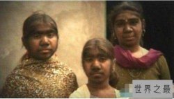 世界十大兽孩之狼孩的故事，喜欢吃生肉还咬人(图片)