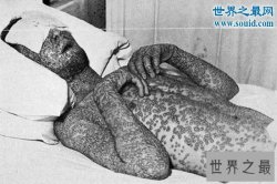世界十大恐怖流行病，已夺走数亿人的生命