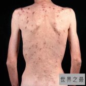 盘点世界五大绝症，如不解决恐毁灭人类