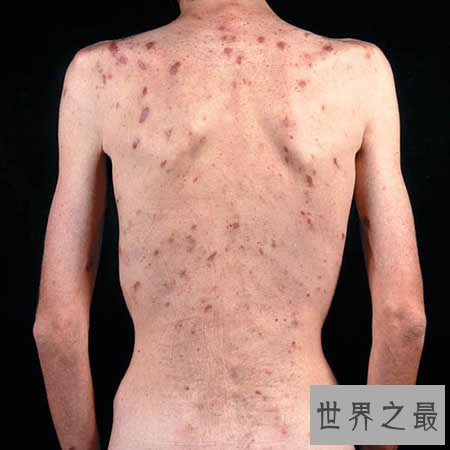 盘点世界五大绝症，如不解决恐毁灭人类