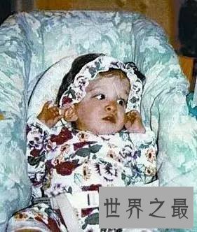世界人类史上十大怪胎，女童如外星人