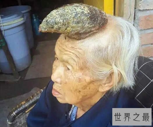 中国87岁老太头上长出牛角,太恐怖