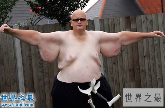 世界上最胖的人减掉500斤肉,皮肤下垂吓死人