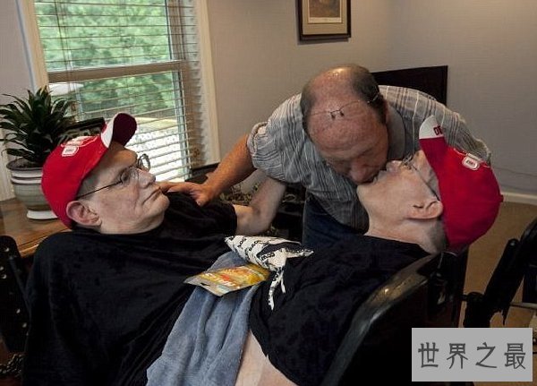 世界上最长寿的连体双胞胎，腰部相连面部相对达63岁