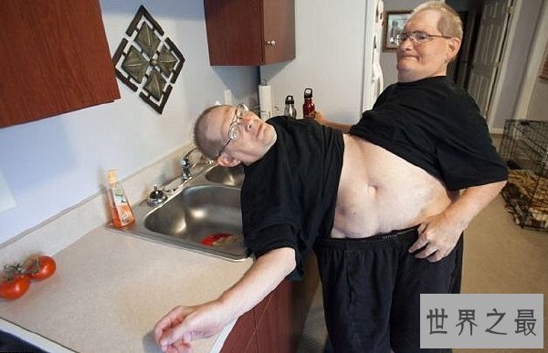 世界上最长寿的连体双胞胎，腰部相连面部相对达63岁