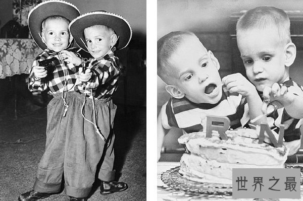 世界上最长寿的连体双胞胎，腰部相连面部相对达63岁