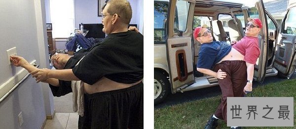 世界上最长寿的连体双胞胎，腰部相连面部相对达63岁