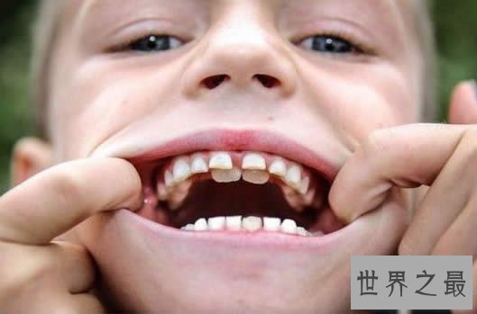 世界上牙齿最多的人,比正常人多9颗(图)
