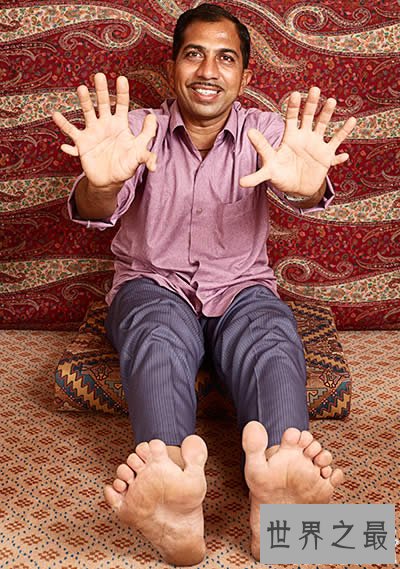 世界上最多的手指和脚趾,一共有28根