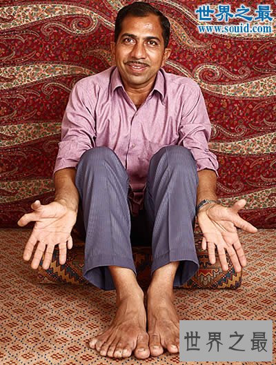 世界上最多的手指和脚趾,一共有28根