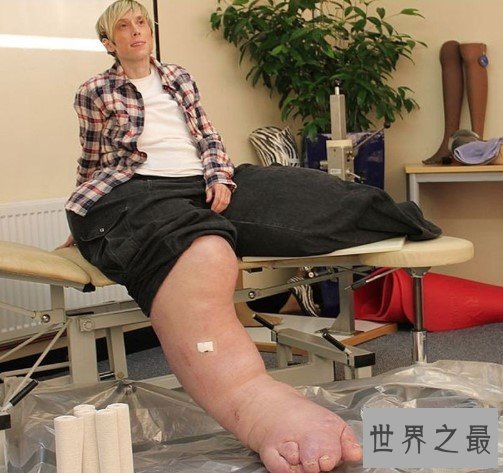 世界上最大最粗的腿,两腿达到了108公斤