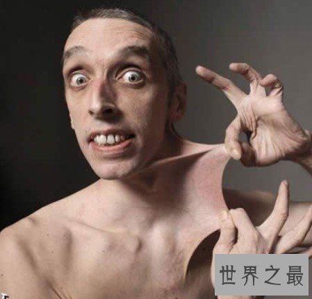 世界上皮肤最有弹性的人,任意拉扯皮肤,长度达到15.8厘米
