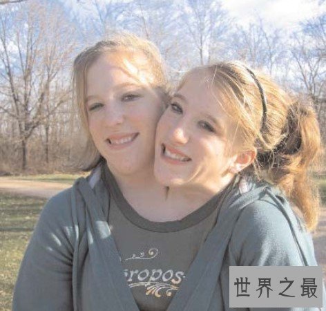 最坚强的连体双头人姐妹,共用一个生殖器官来繁育后代