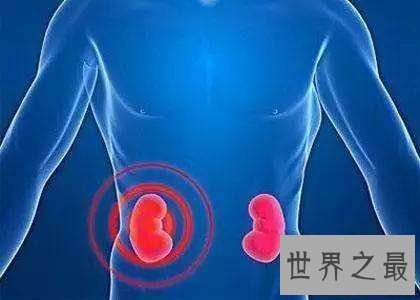 世界上肾最多的人,新西兰男子同时拥有5个正常肾脏