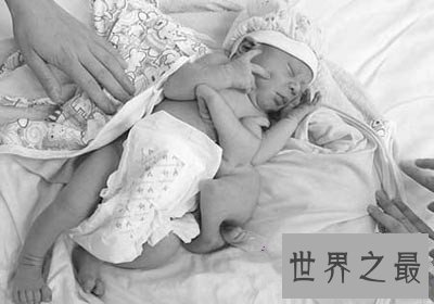 世界上肾最多的人,新西兰男子同时拥有5个正常肾脏