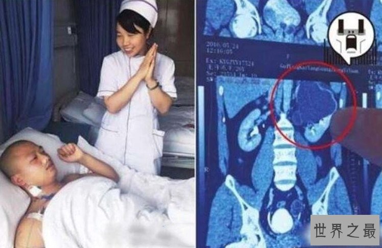 世界上肾最多的人,新西兰男子同时拥有5个正常肾脏