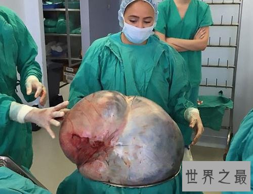 盘点世界最不可思议的5大人体奇闻,女人长4个乳房?
