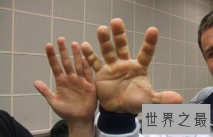 世界上最大的手,手比头大每只手重8公斤,被村民称为恶魔之手!
