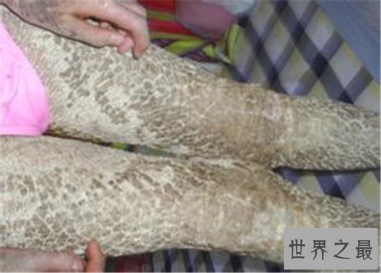 世界最奇怪的病,这种病太恐怖了简直头皮发麻!