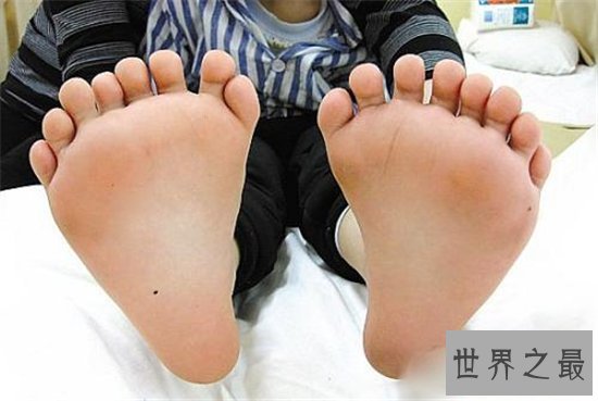 世界上最多手指和脚趾的人,脚趾手指加起来二十多跟!