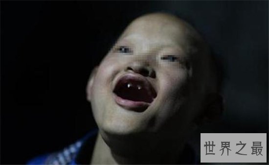 世界上最可怕的怪病,一起来看一下啊吸血鬼症多可怕!