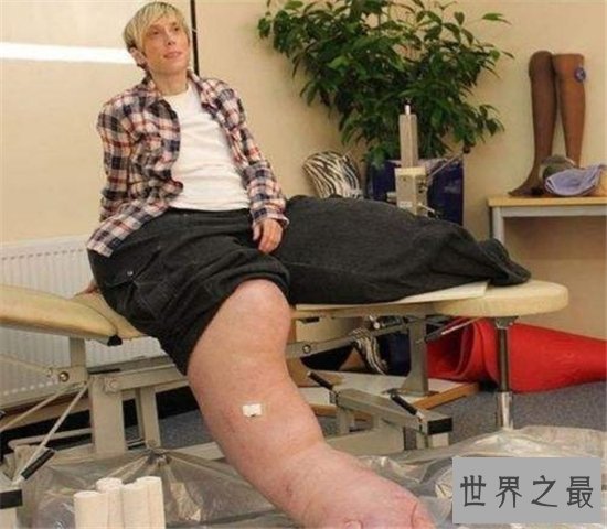 世界最粗的腿,正常人难以想象!