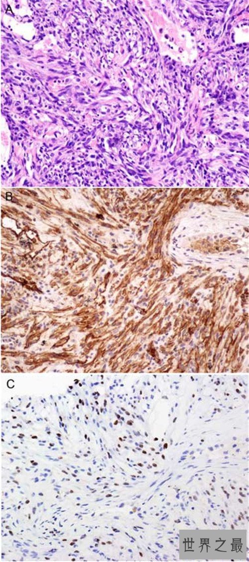世界上最早被发现的艾滋病,从美国发现的瘟疫之源
