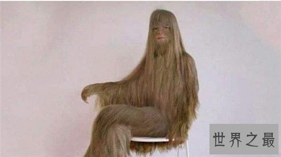 艾米丽·苏珊满身毛发的原因,这是不常见的返祖现象