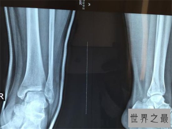 关于人体骨骼的十大事实，人体骨骼的这些奥秘你都知道吗？