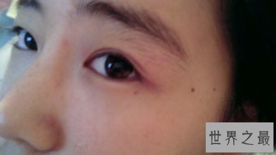 痣是怎么形成的?大部分都是因为人的基因原因