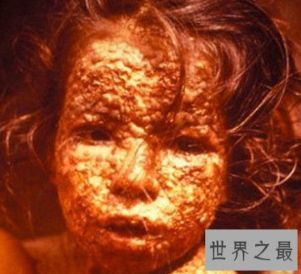 已被人类降服的传染病天花病毒 竟夺走了上亿人的生命！
