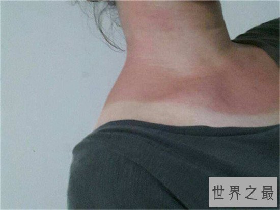 晒伤后怎么处理 简单的家用小窍门来解决