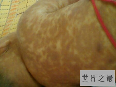 荨麻疹是一种比较难治的症状 荨麻疹偏方是什么呢