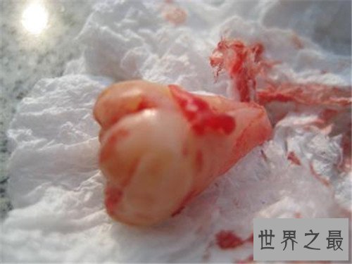 尽头牙是什么意思 智齿真的一定要拔出吗