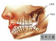 尽头牙是什么意思 智齿真的一定要拔出吗