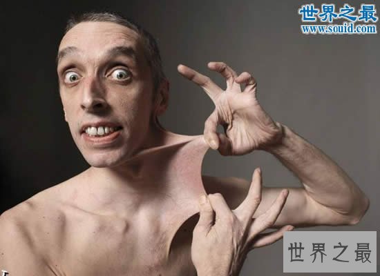 世界上皮肤最有弹性的人,下巴皮肤盖住嘴巴(图)