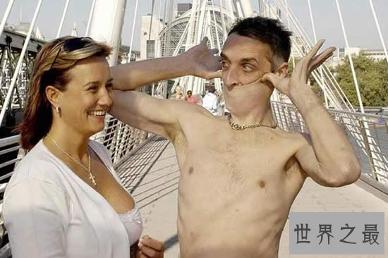 世界上皮肤最有弹性的人,下巴皮肤盖住嘴巴(图)